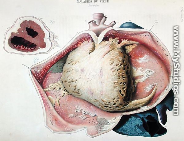 Pericarditis, plate depicting heart diseases from 