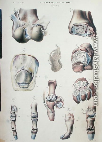Diseases of the joints, from 