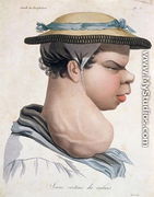 Young Cretin from Valais, illustration from a book by Baron Jean Louis Alibert 1768-1837 - Salvadore Tresca